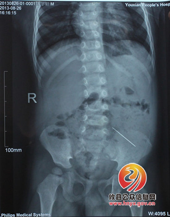2岁幼童吞针命悬一线，县人民医院医护人员除异物化险为夷
